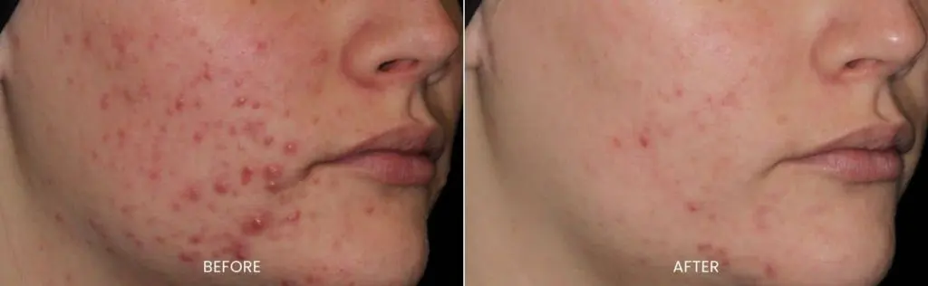 AviClear before and after results at Dermatology Laser Center & Medispa, Owings Mills, MD