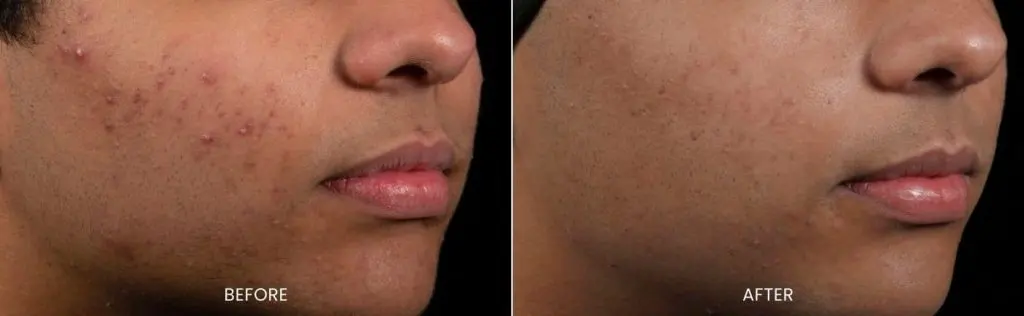 AviClear before and after results at Dermatology Laser Center & Medispa, Owings Mills, MD