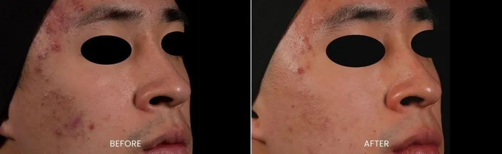 AviClear before and after results at Dermatology Laser Center & Medispa, Owings Mills, MD