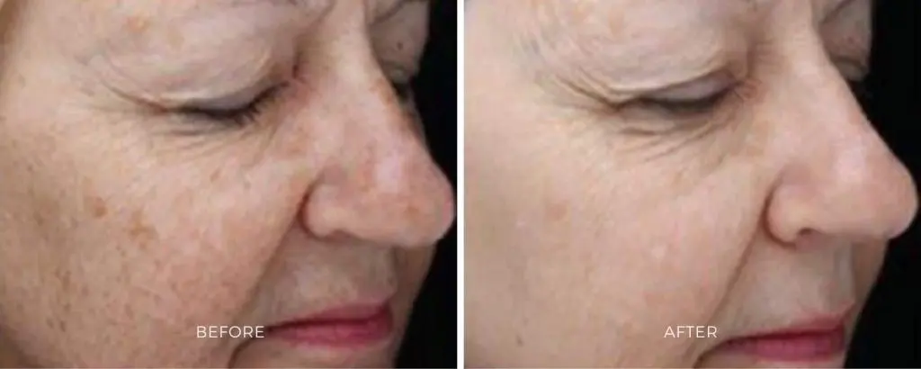BBL HERO laser results pigmentation removal skin rejuvenation Baltimore Maryland