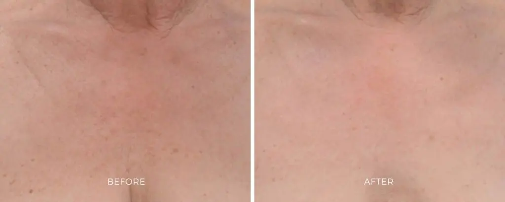 BBL HERO photofacial treatment results age spot removal Baltimore Maryland