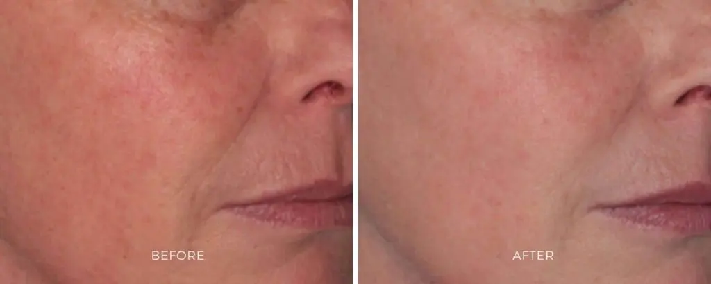 Treatment before and after results at Dermatology Laser Center & Medispa, Owings Mills, MD