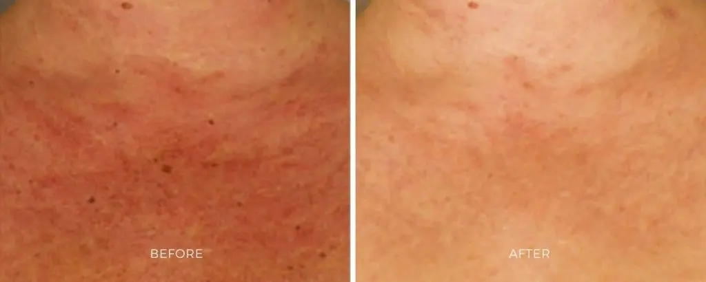 ClearSilk laser treatment results facial redness improvement Baltimore Maryland