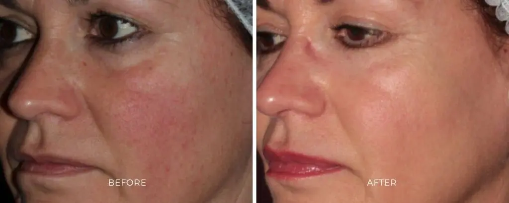 ClearSilk non-ablative laser skin improvement rosacea Baltimore Maryland
