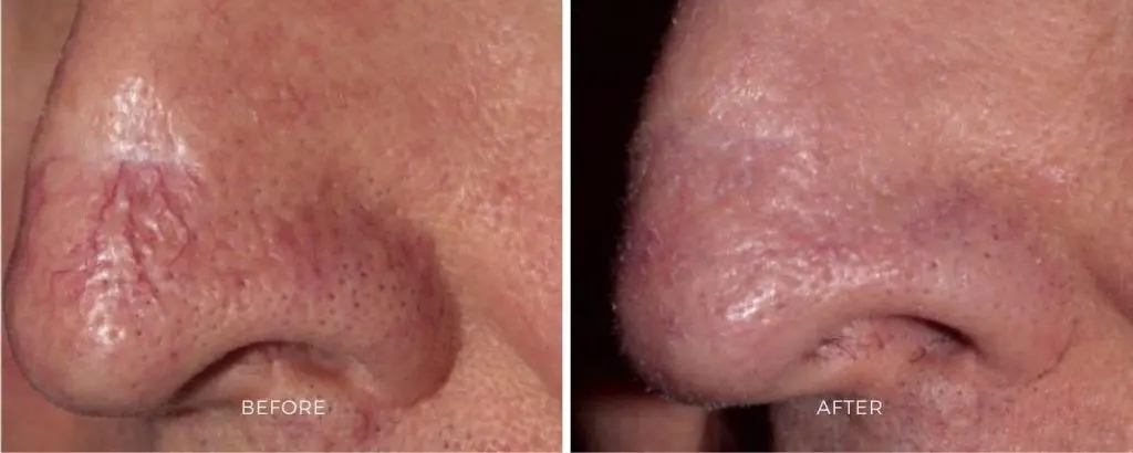 ClearV before and after results at Dermatology Laser Center & Medispa, Owings Mills, MD