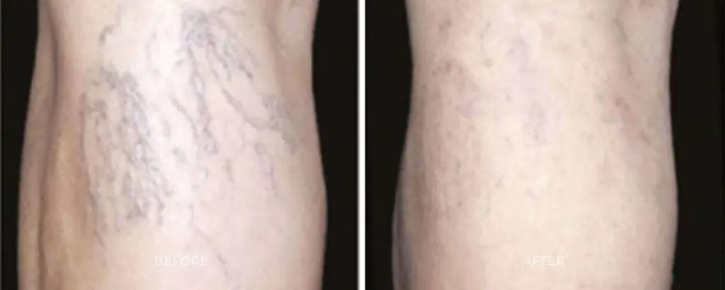ClearV laser spider vein removal face and legs Baltimore Maryland