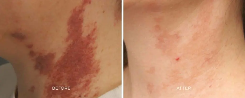 ClearV vascular lesion laser spider vein treatment Baltimore Maryland