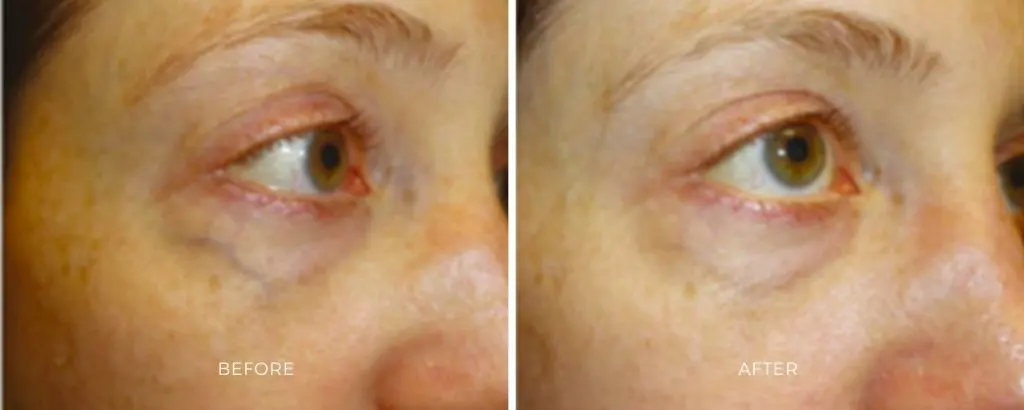 ClearV before and after results at Dermatology Laser Center & Medispa, Owings Mills, MD