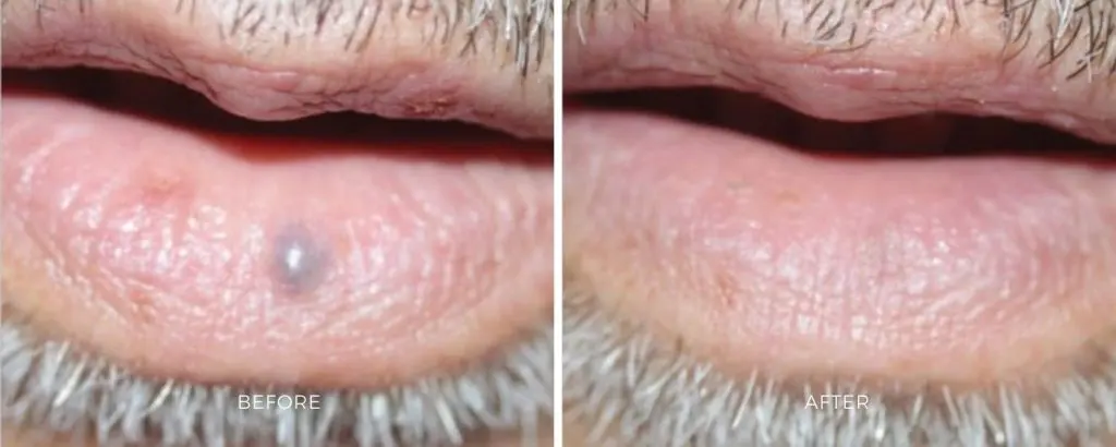 ClearV before and after results at Dermatology Laser Center & Medispa, Owings Mills, MD