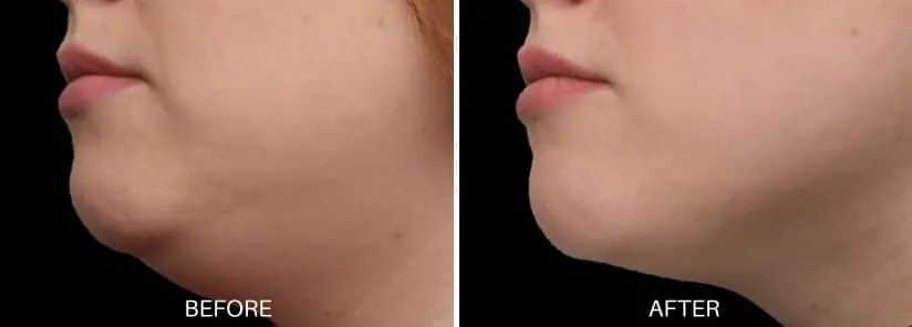 EMface submentum before and after double chin reduction