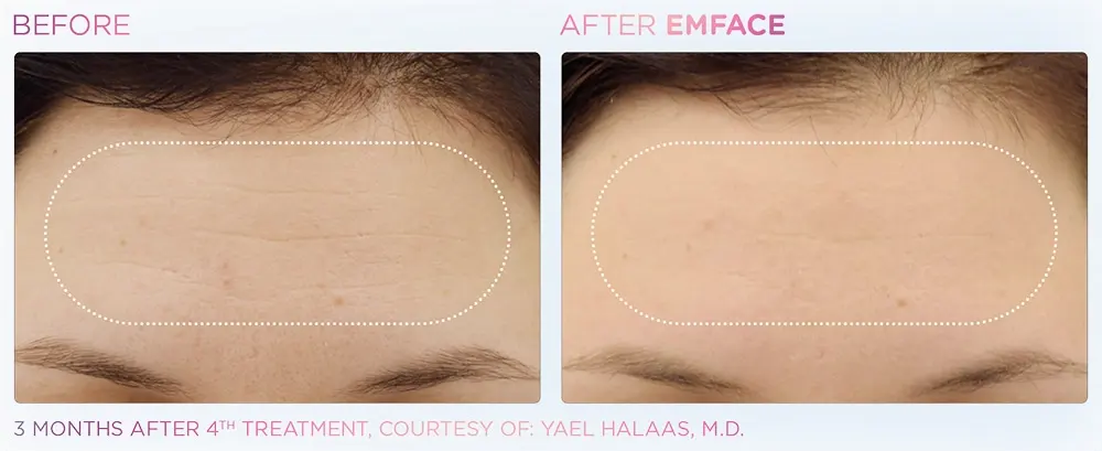 EmFace before and after results at Dermatology Laser Center & Medispa, Owings Mills, MD