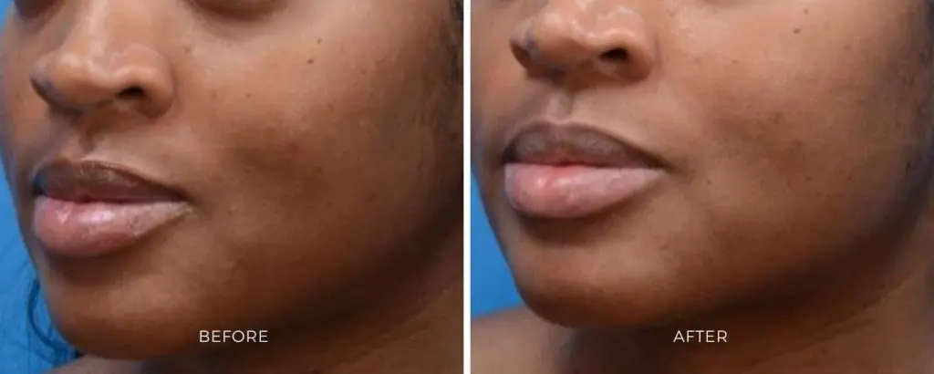 MOXI laser treatment results skin texture improvement Baltimore Maryland