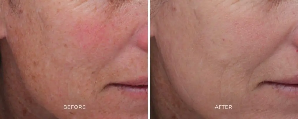 MOXI laser before and after skin rejuvenation results Baltimore Maryland