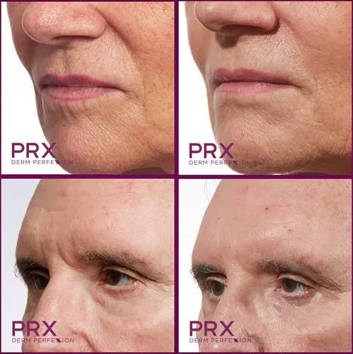 PRX Derm Perfexion before and after results skin tightening rejuvenation