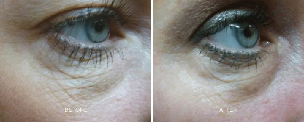 SkinTyte radiofrequency tightening skin laxity treatment Baltimore Maryland