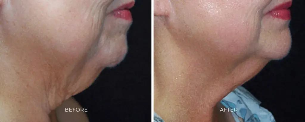 SkinTyte skin tightening treatment results facial rejuvenation Baltimore Maryland