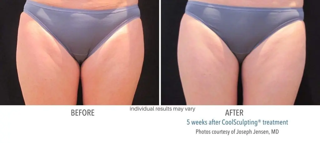 CoolSculpting before and after results at Dermatology Laser Center & Medispa, Owings Mills, MD