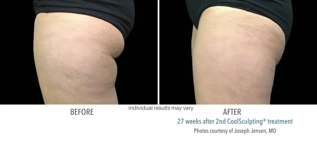 CoolSculpting before and after results at Dermatology Laser Center & Medispa, Owings Mills, MD