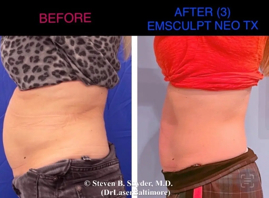 Emsculpt NEO results