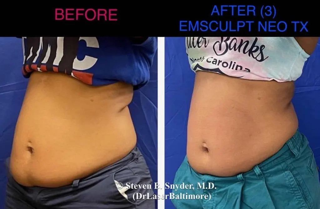 Body contouring results