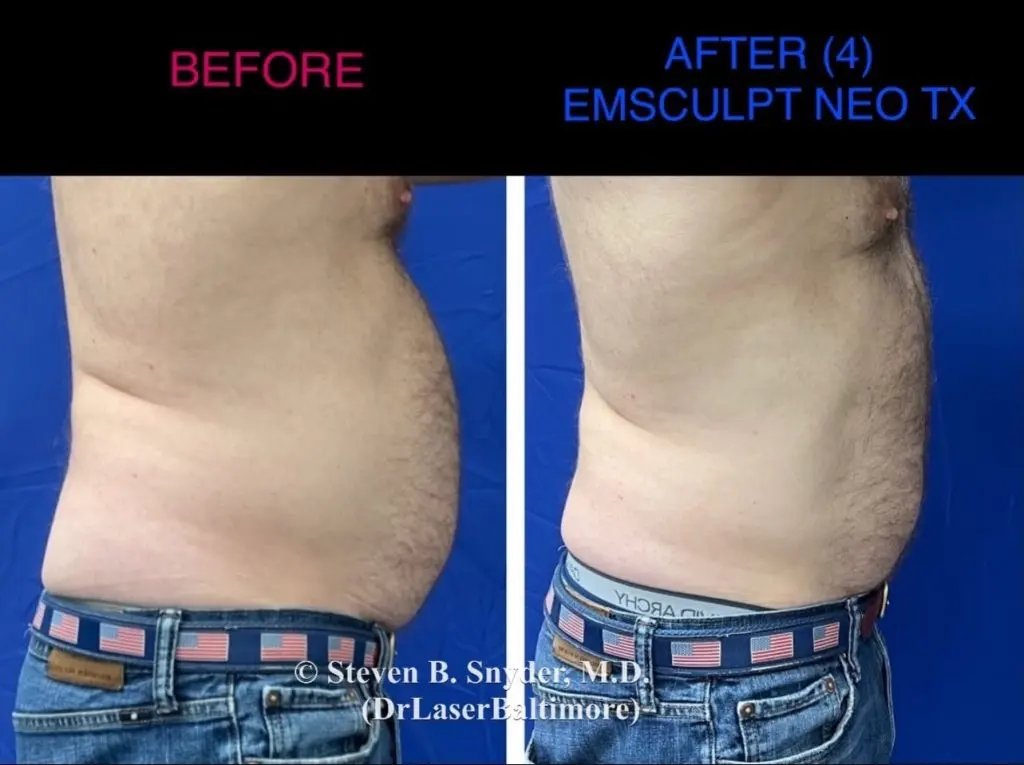 Treatment before and after results at Dermatology Laser Center & Medispa, Owings Mills, MD