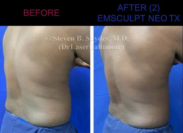 Treatment before and after results at Dermatology Laser Center & Medispa, Owings Mills, MD