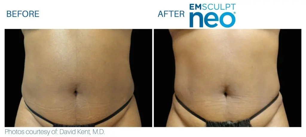 Emsculpt NEO before and after results at Dermatology Laser Center & Medispa, Owings Mills, MD