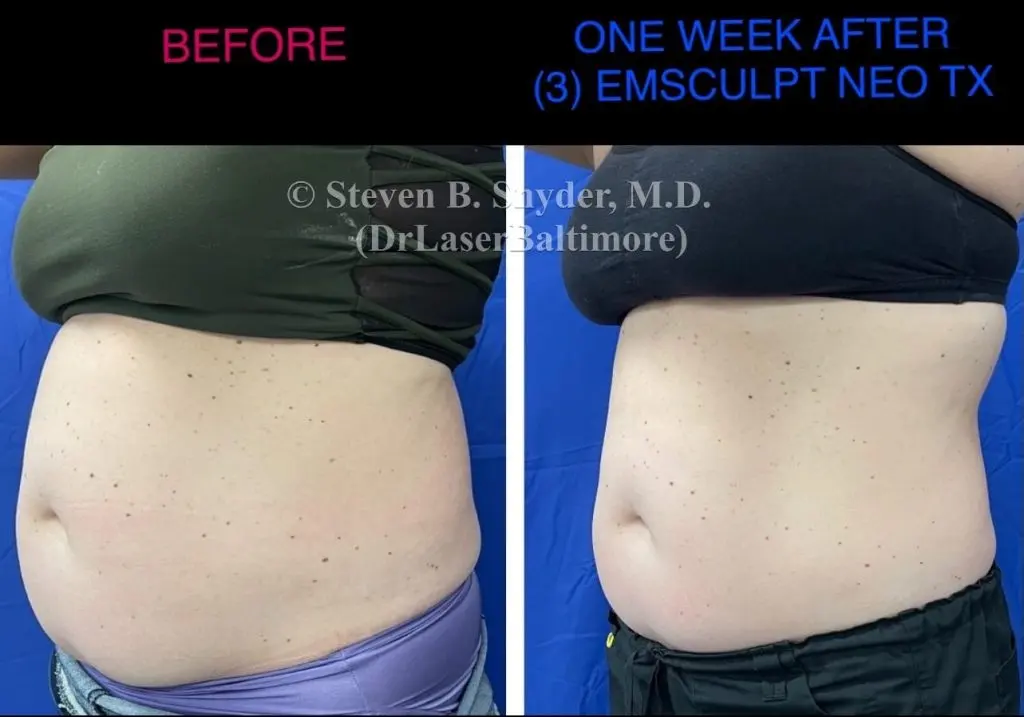 Emsculpt NEO before and after results at Dermatology Laser Center & Medispa, Owings Mills, MD