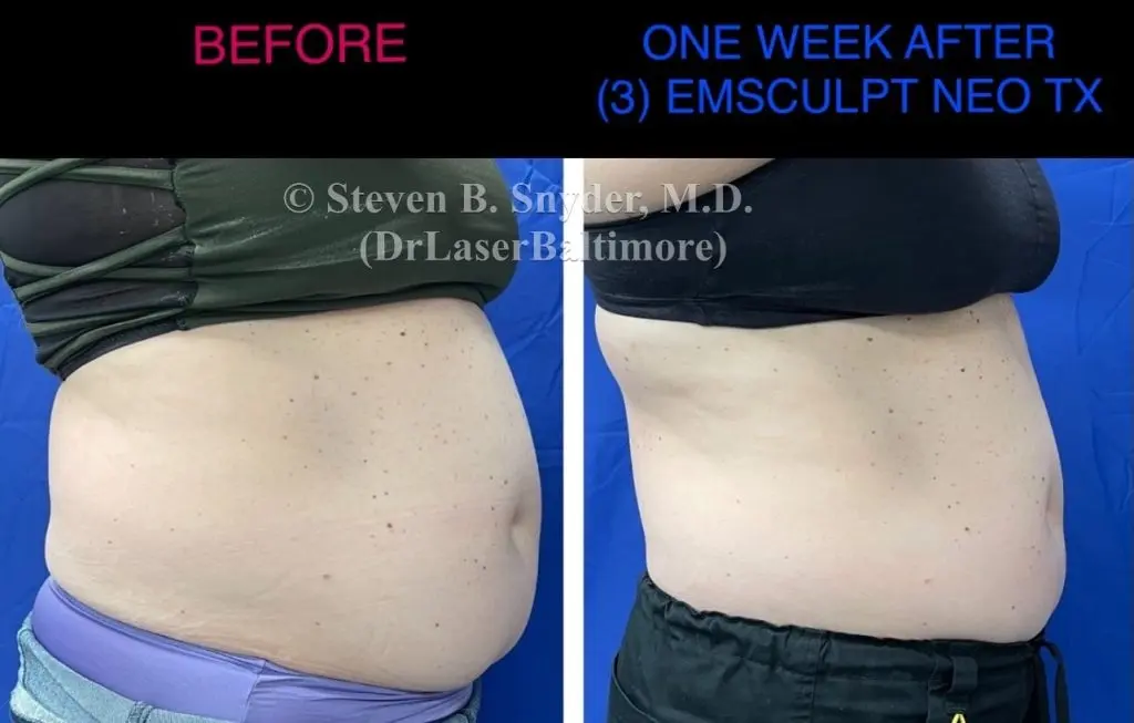 Emsculpt NEO before and after results at Dermatology Laser Center & Medispa, Owings Mills, MD