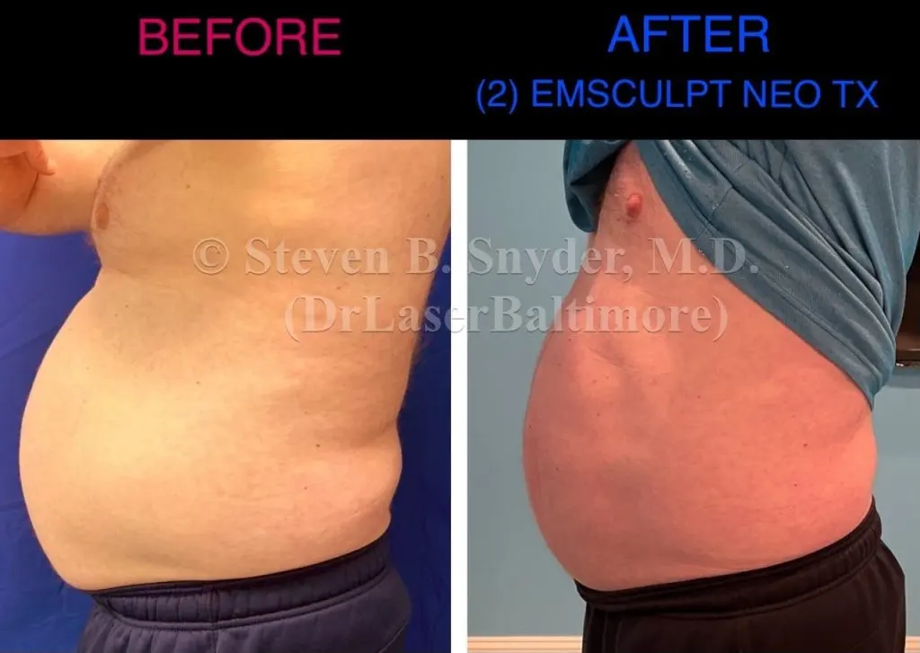Emsculpt NEO before and after results at Dermatology Laser Center & Medispa, Owings Mills, MD