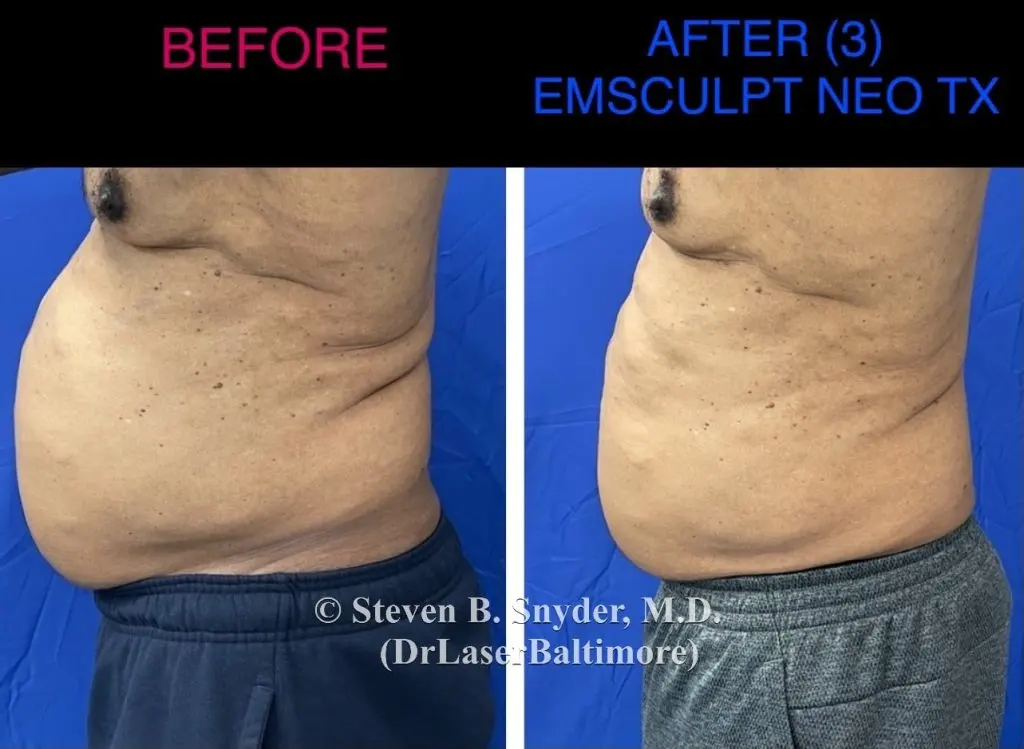 Emsculpt NEO before and after results at Dermatology Laser Center & Medispa, Owings Mills, MD
