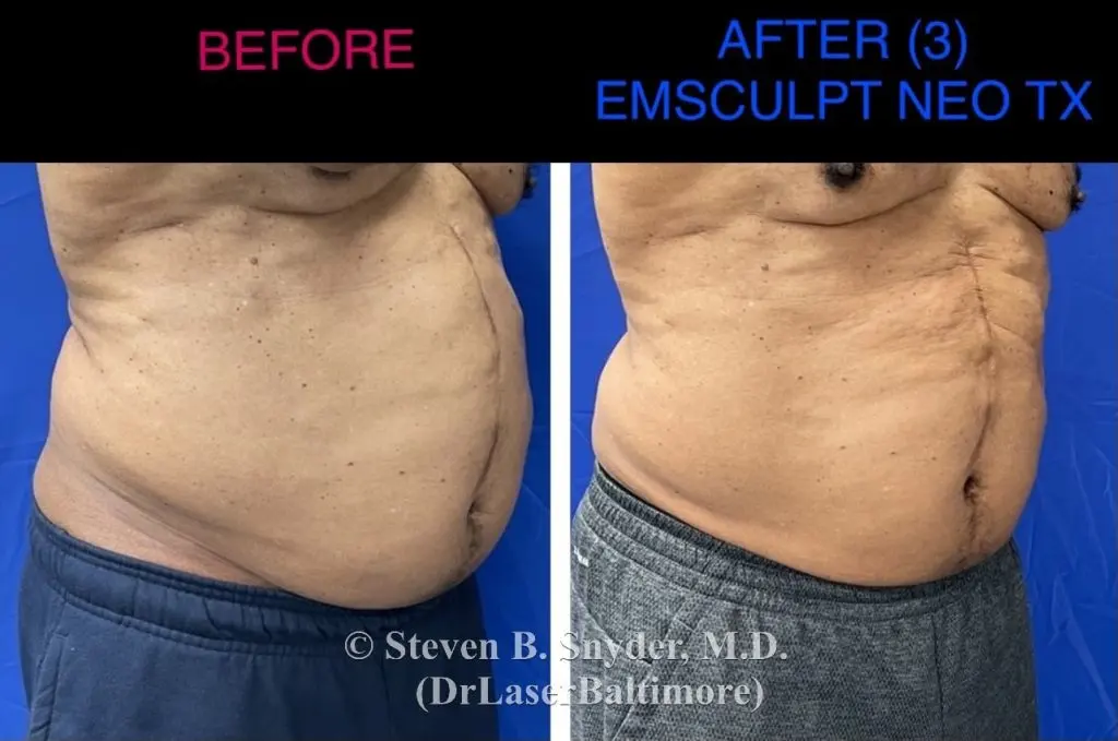 Emsculpt NEO before and after results at Dermatology Laser Center & Medispa, Owings Mills, MD