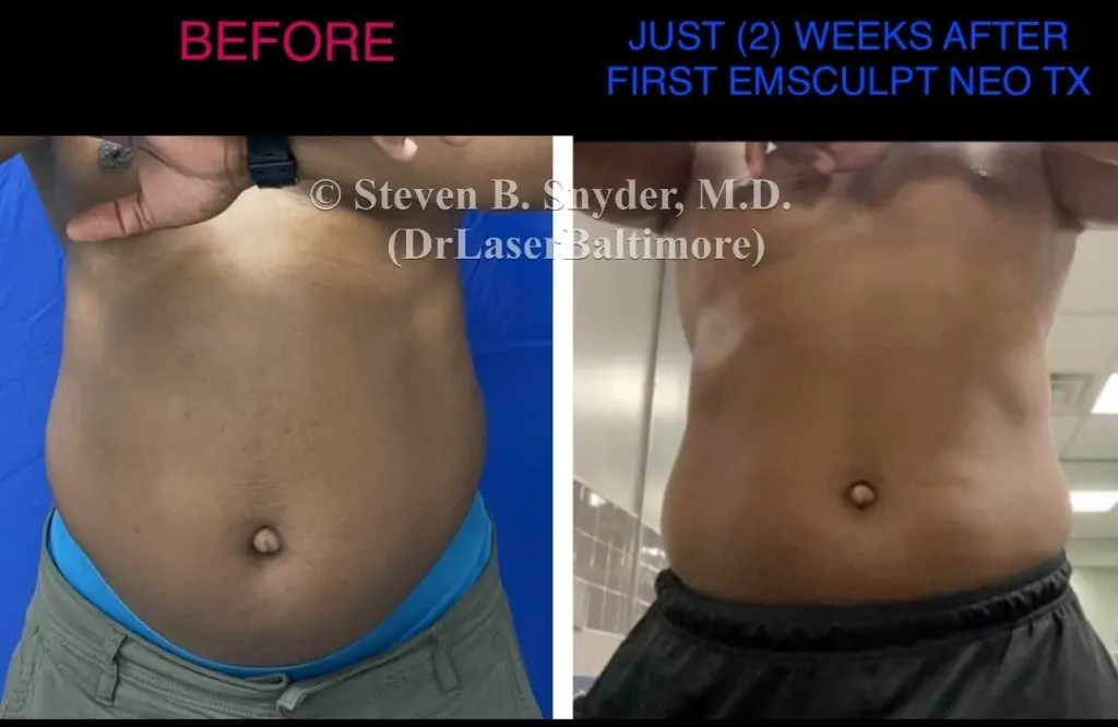 Emsculpt NEO before and after results at Dermatology Laser Center & Medispa, Owings Mills, MD