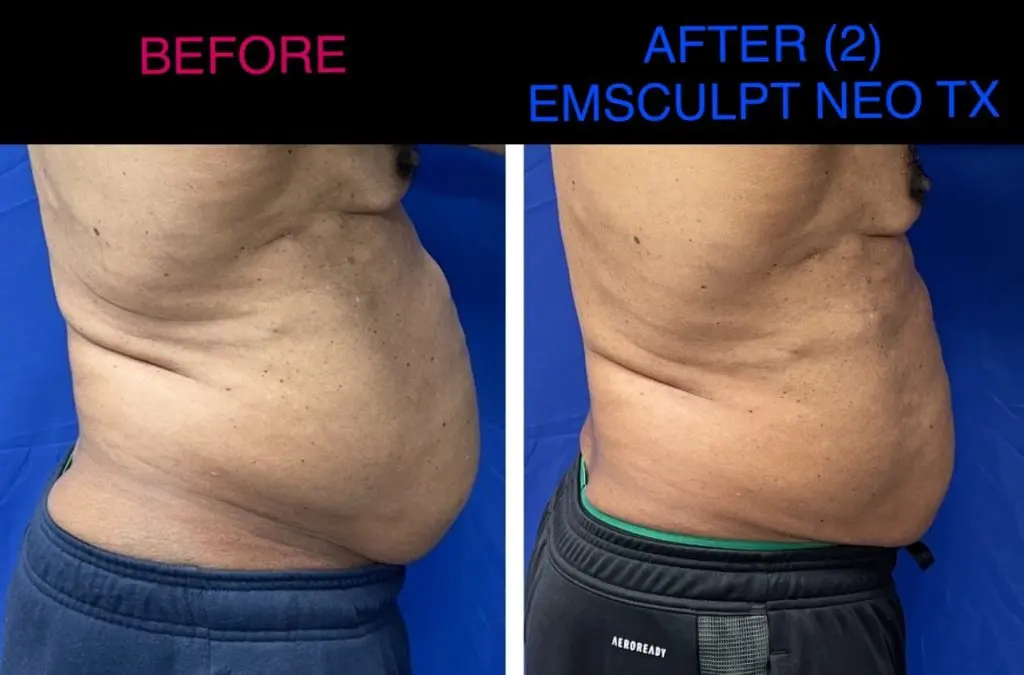 Emsculpt NEO before and after results at Dermatology Laser Center & Medispa, Owings Mills, MD