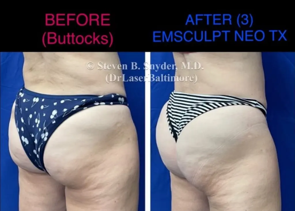 Emsculpt NEO before and after results at Dermatology Laser Center & Medispa, Owings Mills, MD