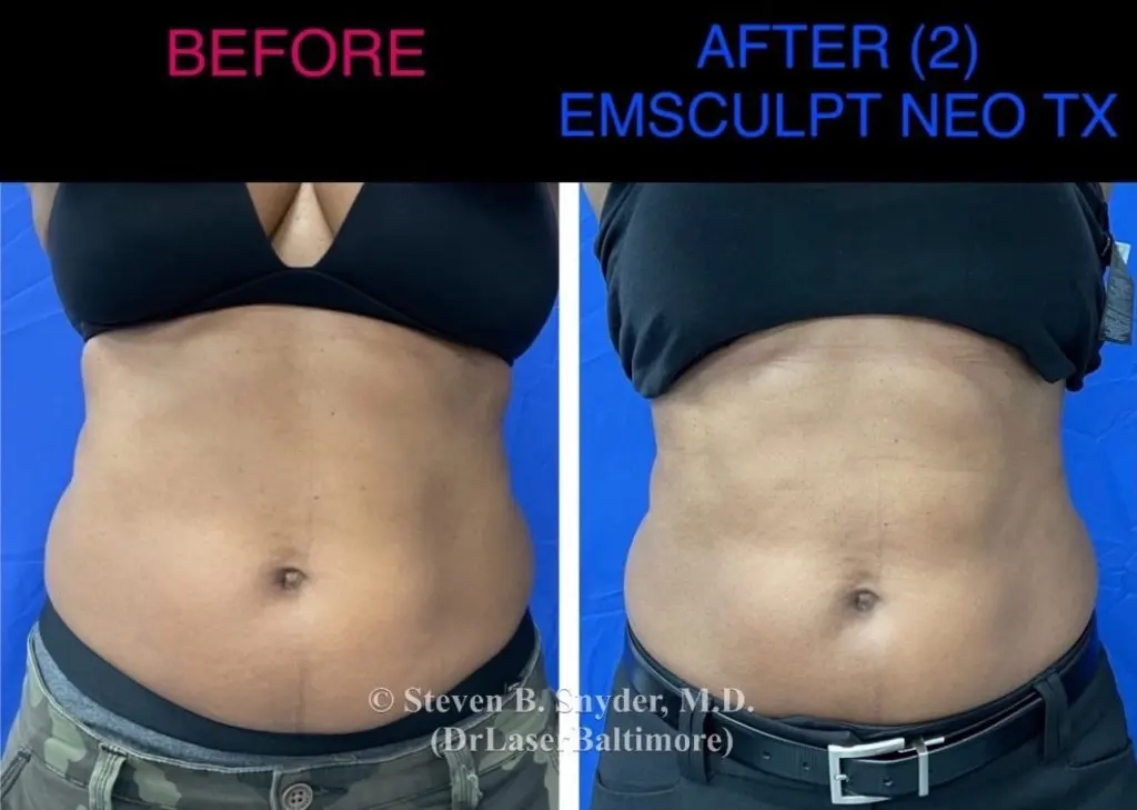 Emsculpt NEO before and after results at Dermatology Laser Center & Medispa, Owings Mills, MD