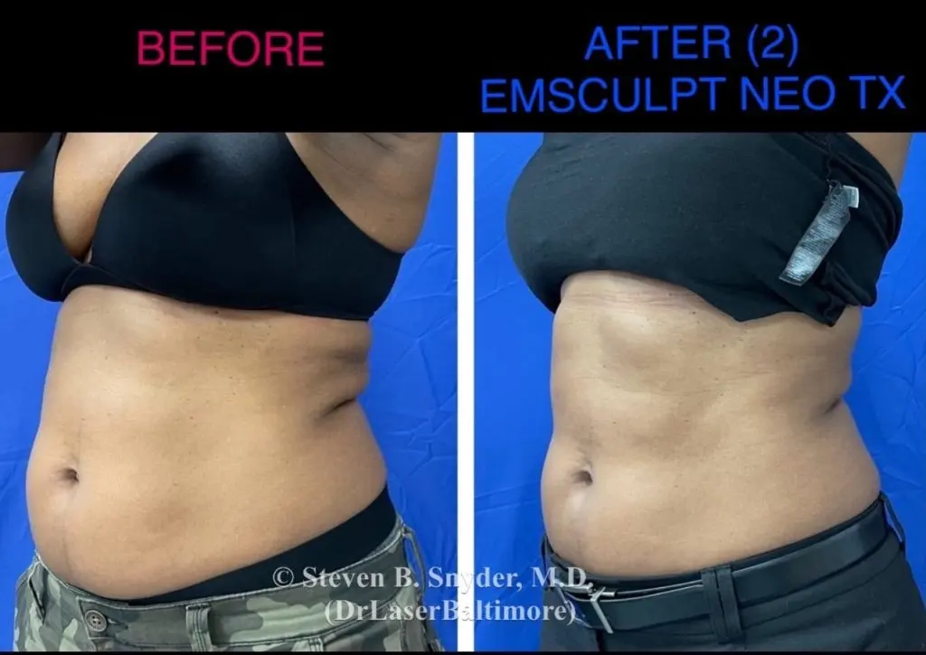 Emsculpt NEO before and after results at Dermatology Laser Center & Medispa, Owings Mills, MD