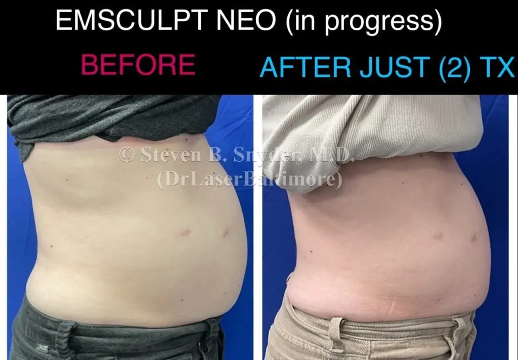 Emsculpt NEO before and after results at Dermatology Laser Center & Medispa, Owings Mills, MD