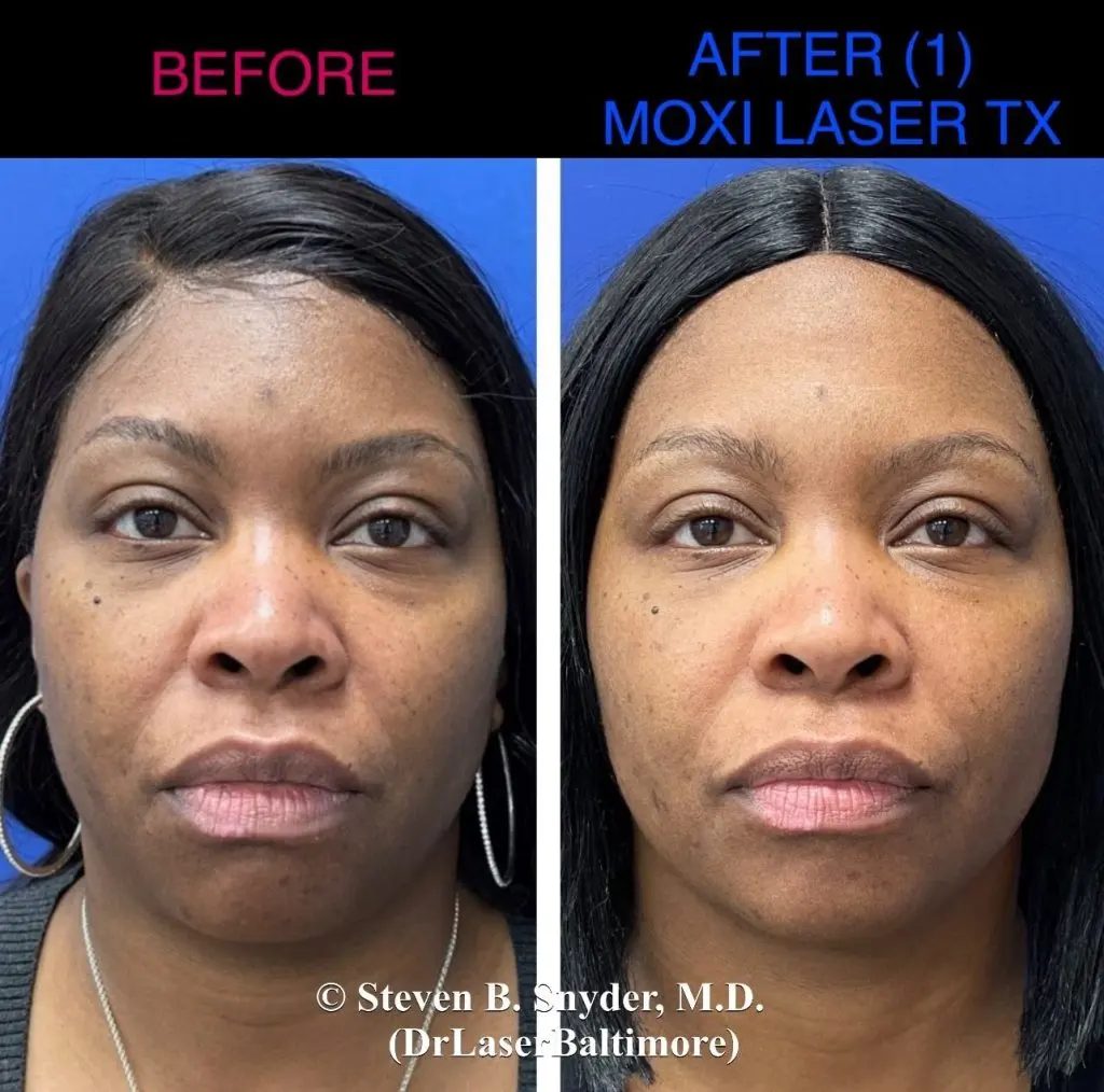 Moxi laser before and after results at Dermatology Laser Center & Medispa, Owings Mills, MD