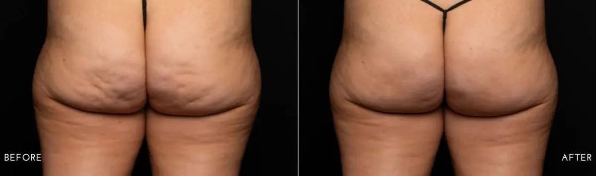 Aveli-cellulite-treatment-before-and-after-image-1