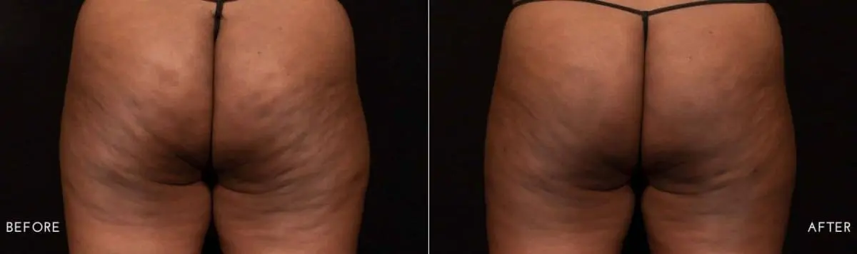 Aveli-cellulite-treatment-before-and-after-image-3