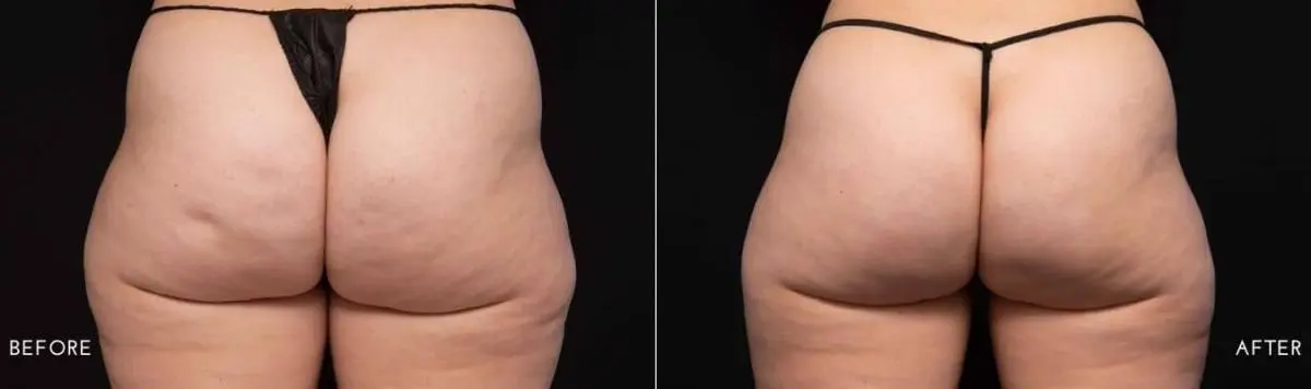 Aveli-cellulite-treatment-before-and-after-image-4