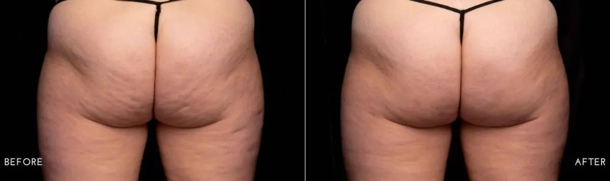 Aveli-cellulite-treatment-before-and-after-image-5