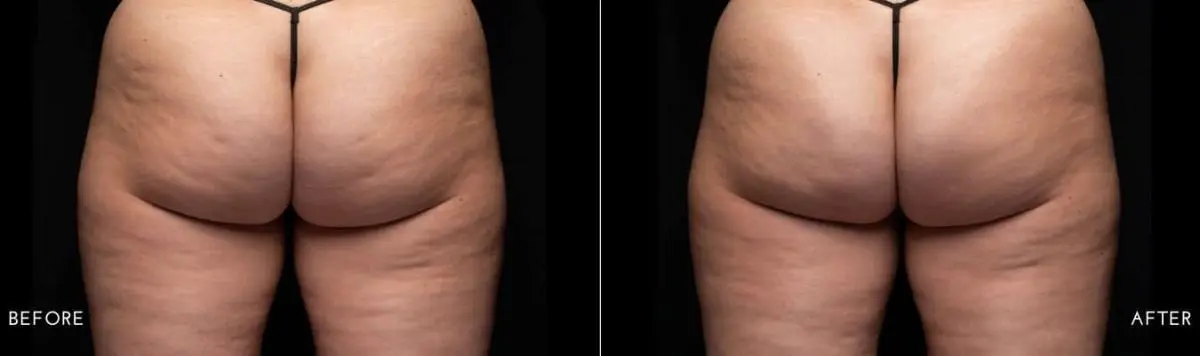 Aveli-cellulite-treatment-before-and-after-image-6