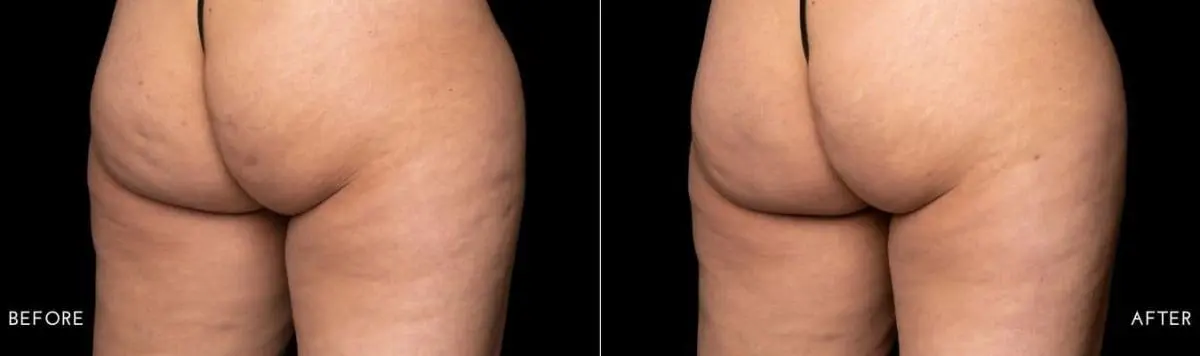 Aveli-cellulite-treatment-before-and-after-image-8