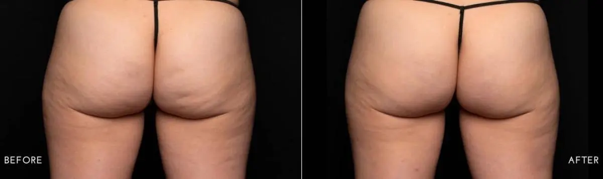 Aveli-cellulite-treatment-before-and-after-treatment-2