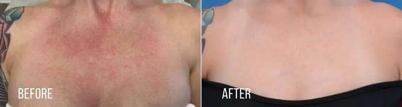 BBL-Hero-before-and-after-1