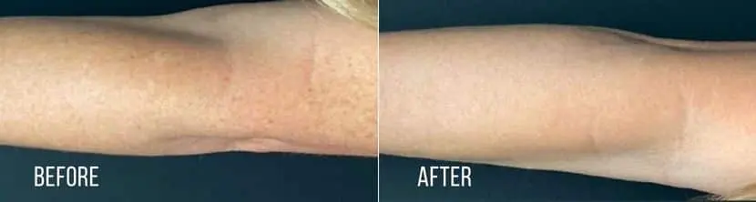 BBL-Hero-before-and-after-3