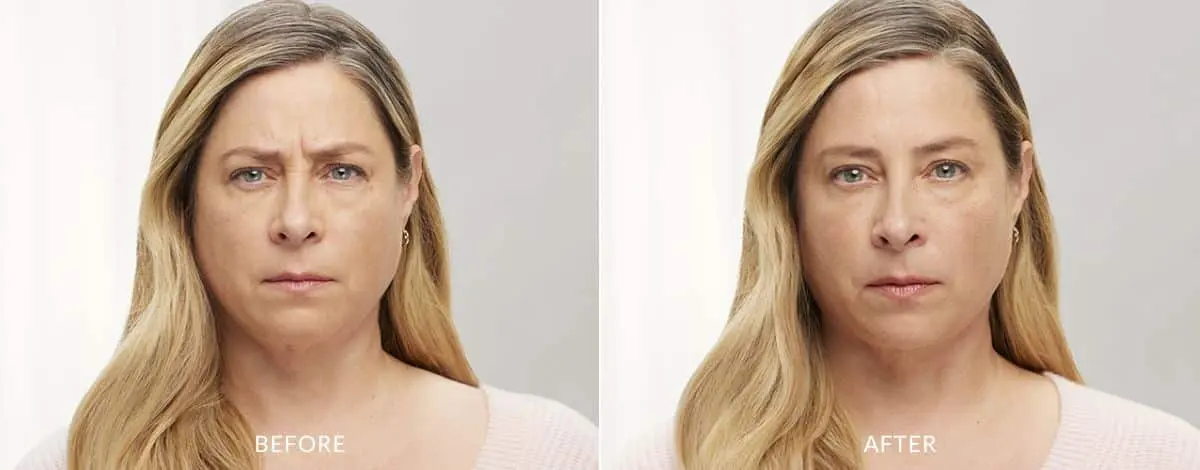 Botox-before-and-after-Laser-Center-and-MediSpa-1