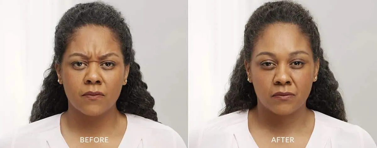 Botox-before-and-after-Laser-Center-and-MediSpa-2